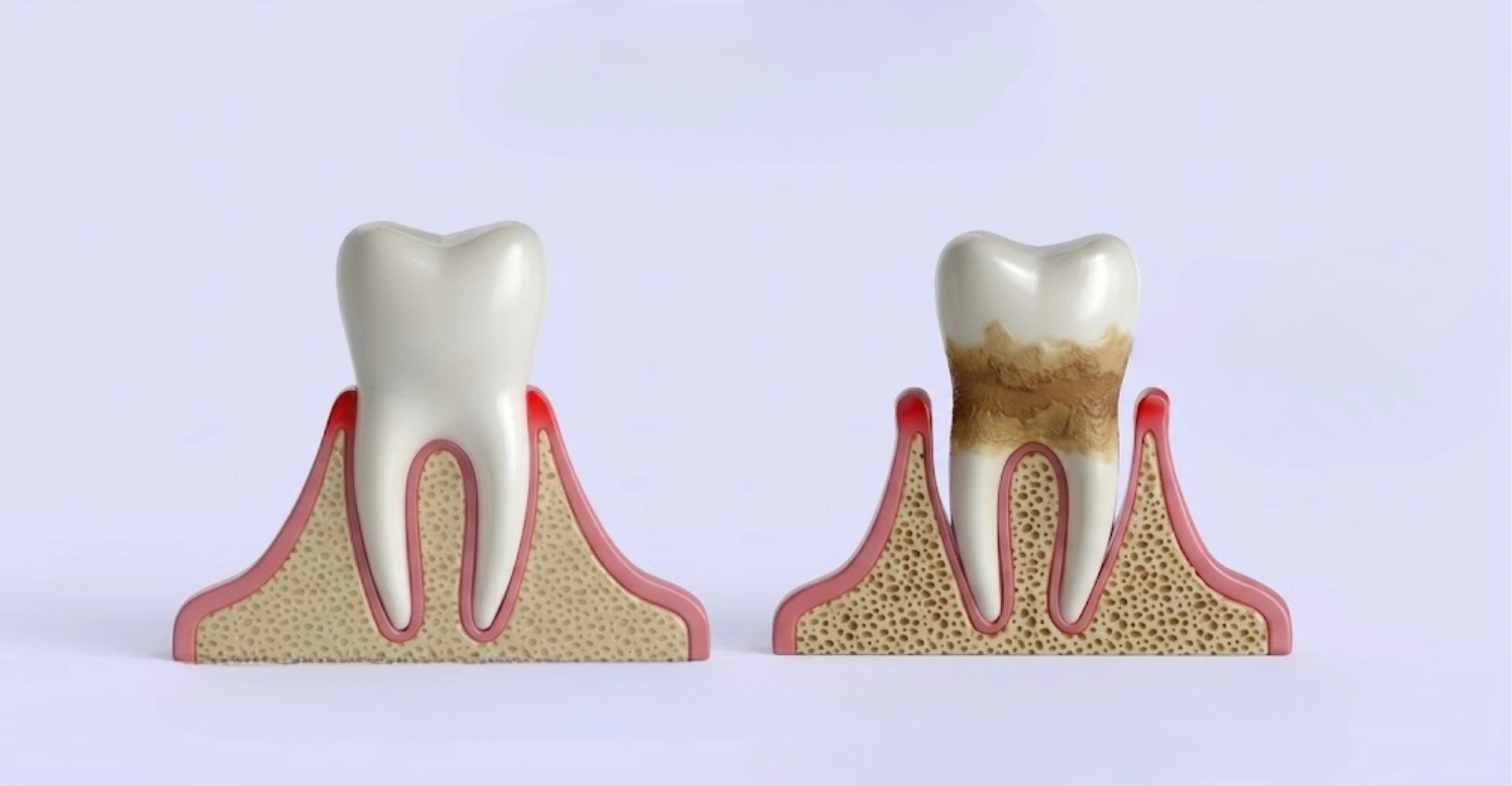 Plaque and Gum disease treatment 2